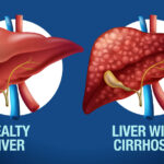 Liver Cirrhosis Explained Causes, Symptoms, And Complications