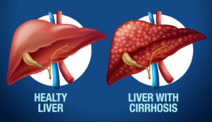 Liver Cirrhosis Explained Causes, Symptoms, And Complications