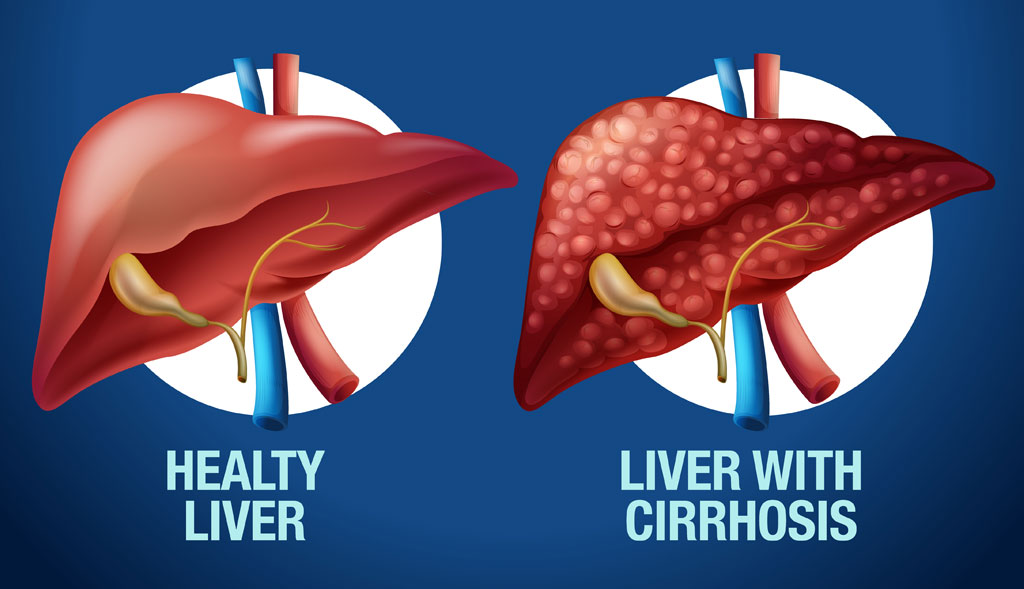 Liver Cirrhosis Explained Causes, Symptoms, And Complications